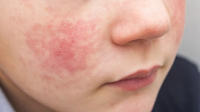 Mengenal Eksim: Penyebab, Pengobatan, dan Cara Mencegah Kekambuhan